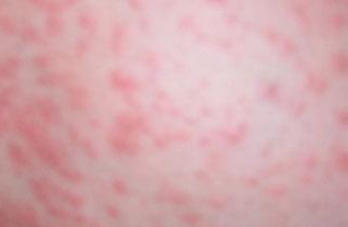 在接触部位发生境界清楚的红斑,丘疹,丘疱疹,严重时红肿并出现水疱或
